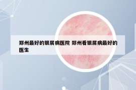 郑州最好的银屑病医院 郑州看银屑病最好的医生