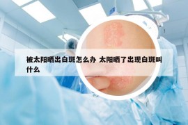 被太阳晒出白斑怎么办 太阳晒了出现白斑叫什么