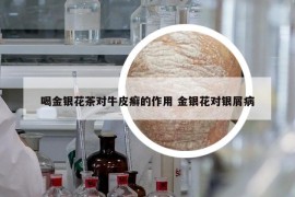 喝金银花茶对牛皮癣的作用 金银花对银屑病