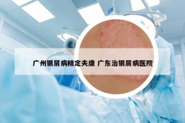 广州银屑病精定夫康 广东治银屑病医院