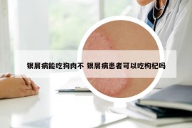 银屑病能吃狗肉不 银屑病患者可以吃枸杞吗