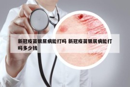 新冠疫苗银屑病能打吗 新冠疫苗银屑病能打吗多少钱