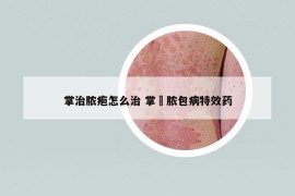 掌治脓疱怎么治 掌砋脓包病特效药