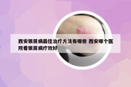 西安银屑病最佳治疗方法有哪些 西安哪个医院看银屑病疗效好
