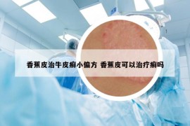 香蕉皮治牛皮癣小偏方 香蕉皮可以治疗癣吗