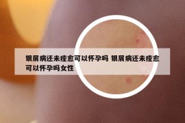 银屑病还未痊愈可以怀孕吗 银屑病还未痊愈可以怀孕吗女性