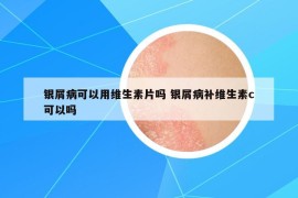 银屑病可以用维生素片吗 银屑病补维生素c可以吗