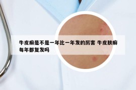 牛皮癣是不是一年比一年发的厉害 牛皮肤癣每年都复发吗