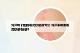 菏泽哪个医院看皮肤病最专业 菏泽市哪里看皮肤病看的好