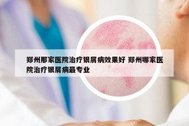 郑州那家医院治疗银屑病效果好 郑州哪家医院治疗银屑病最专业