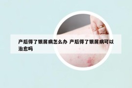 产后得了银屑病怎么办 产后得了银屑病可以治愈吗