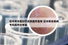 佳木斯市最好的皮肤医院是哪 佳木斯皮肤病专科医院在哪里