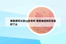 银屑病可以涂vg软膏吗 银屑病涂抹药膏能好了么