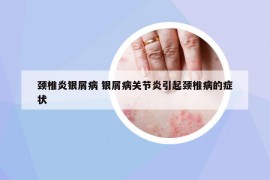 颈椎炎银屑病 银屑病关节炎引起颈椎病的症状