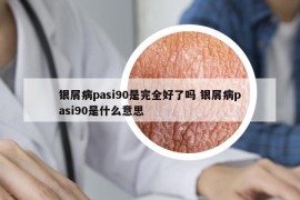 银屑病pasi90是完全好了吗 银屑病pasi90是什么意思