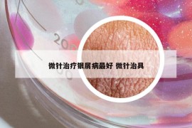 微针治疗银屑病最好 微针治具
