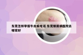 东莞怎样举报牛皮癣电话 东莞银屑病医院去哪家好