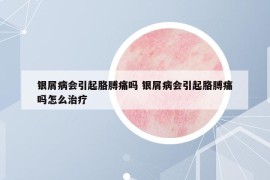 银屑病会引起胳膊痛吗 银屑病会引起胳膊痛吗怎么治疗