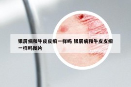 银屑病和牛皮皮癣一样吗 银屑病和牛皮皮癣一样吗图片