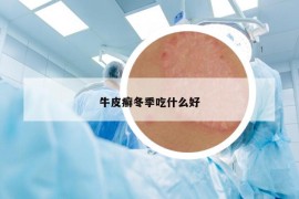 牛皮癣冬季吃什么好