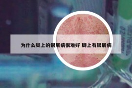 为什么脚上的银屑病很难好 脚上有银屑病