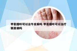 甲氨蝶呤可以冶牛皮癣吗 甲氨蝶呤可以治疗银屑病吗