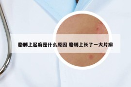 胳膊上起癣是什么原因 胳膊上长了一大片癣