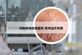 河南郑州白斑医院 郑州治疗白斑