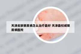 天津皮肤银屑病怎么治疗最好 天津最权威银屑病医院
