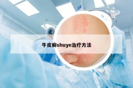 牛皮癣shuye治疗方法