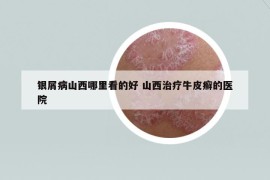 银屑病山西哪里看的好 山西治疗牛皮癣的医院