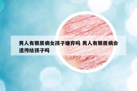 男人有银屑病女孩子嫌弃吗 男人有银屑病会遗传给孩子吗