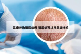 氟康唑治银屑病吗 银屑病可以用氟康唑吗