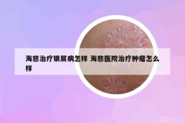 海慈治疗银屑病怎样 海慈医院治疗肿瘤怎么样