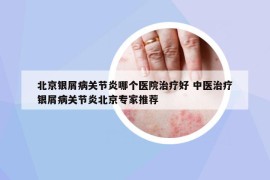 北京银屑病关节炎哪个医院治疗好 中医治疗银屑病关节炎北京专家推荐