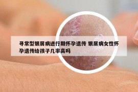 寻常型银屑病进行期怀孕遗传 银屑病女性怀孕遗传给孩子几率高吗