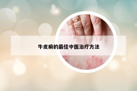 牛皮癣的最佳中医治疗方法