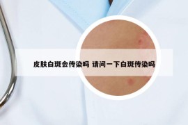 皮肤白斑会传染吗 请问一下白斑传染吗