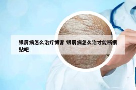 银屑病怎么治疗博客 银屑病怎么治才能断根贴吧