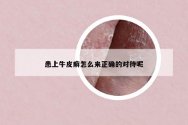 患上牛皮癣怎么来正确的对待呢