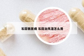 石蒜银屑病 石蒜治风湿怎么用
