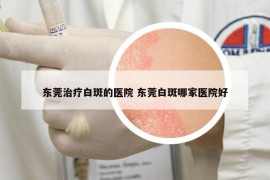 东莞治疗白斑的医院 东莞白斑哪家医院好