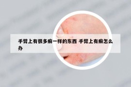 手臂上有很多癣一样的东西 手臂上有癣怎么办