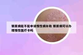 银屑病能不能申请慢性病补助 银屑病可以办理慢性医疗卡吗