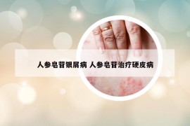 人参皂苷银屑病 人参皂苷治疗硬皮病
