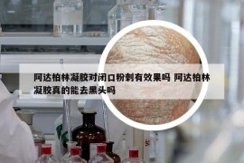 阿达柏林凝胶对闭口粉刺有效果吗 阿达柏林凝胶真的能去黑头吗