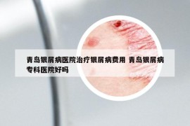 青岛银屑病医院治疗银屑病费用 青岛银屑病专科医院好吗