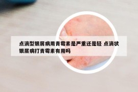 点滴型银屑病用青霉素是严重还是轻 点滴状银屑病打青霉素有用吗