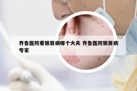 齐鲁医院看银屑病哪个大夫 齐鲁医院银屑病专家