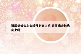 银屑病长头上会转移到身上吗 银屑病会长头皮上吗